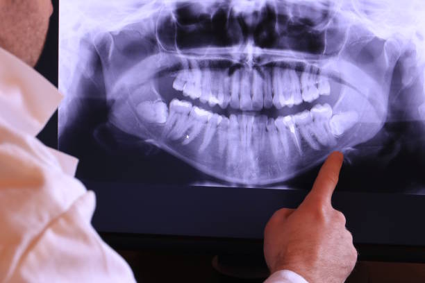Best Emergency Wisdom Teeth Removal in Stansberry Lake, WA